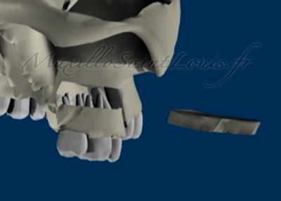 Exérèse d'une tranche osseuse horizontale (vue coté)
