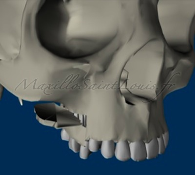 Exérèse d'une tranche osseuse horizontale (vue 3/4 ant)