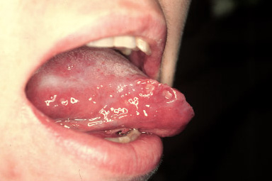 Exemple de lésions muqueuses de la cavité buccale