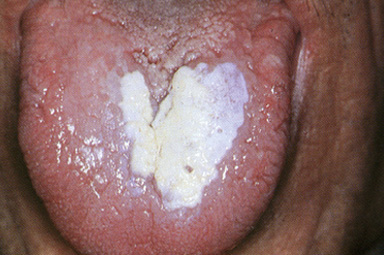 Exemple de lésions muqueuses de la cavité buccale