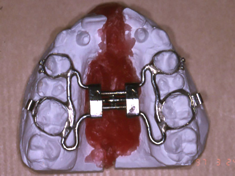 Simulation (en rouge) du gain transversal (largeur) du maxillaire après disjonction. L’os va se reformer en 2 à 3 mois
